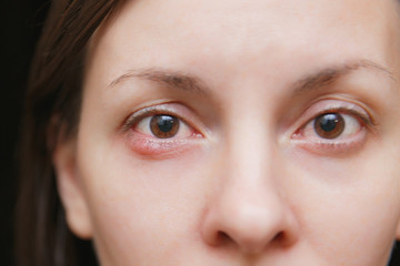 Close up photo of young caucasian brunette woman barley brown eye infection, eyelid abscess, stye,...