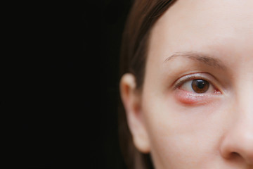 Close up of young caucasian brunette woman barley brown one eye infection, eyelid abscess, stye, hordeolum. Concept of health, disease and treatment. Copy space for advertisement. With place for text.