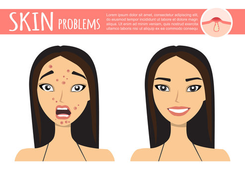 Acne Treatment Before After, Facial Cleansing Foam, Cartoon Illustration