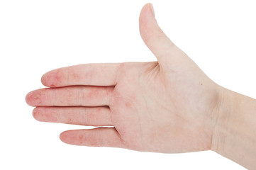 Female hand with dermatitis