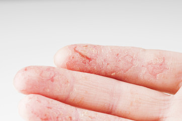 Female hand with dermatitis