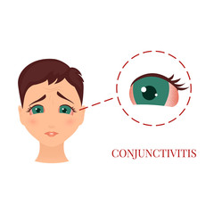 Fototapeta premium Woman with conjunctivitis. Closeup view. Patient with pinkeye. Infectious viral disease. Medical concept. Anatomy of people. Vector illustration. 