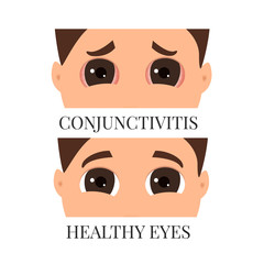 Man with conjunctivitis. Closeup view. Sad patient with pinkeye. Infectious viral disease. Medical concept. Anatomy of people. Vertical vector illustration.