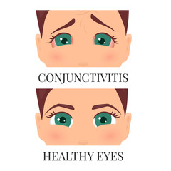 Woman with conjunctivitis. Closeup view. Patient with pinkeye. Infectious viral disease. Medical concept. Anatomy of people. Vertical vector illustration.
