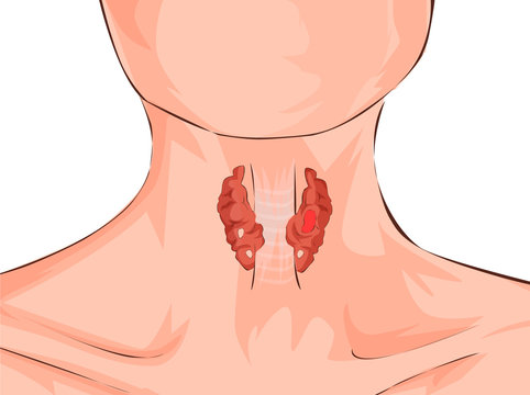 Hyperthyroidism and trachea shown on a woman. Medical concept. Anatomy of people. Vector illustration.