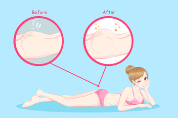 woman with butt implant