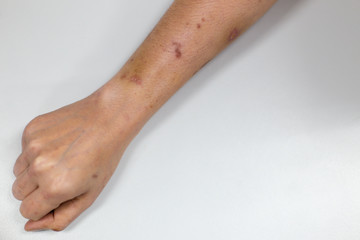 Atopic dermatitis (AD), of inflammation of the skin (dermatitis).