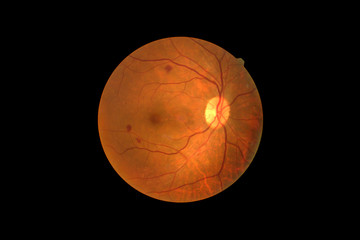 Photo Madical Retina Abnormal isolated on black background.Retina of diabetes   diabates retinopathy. - obrazy, fototapety, plakaty