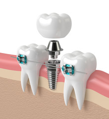 3d render of teeth with implant and braces