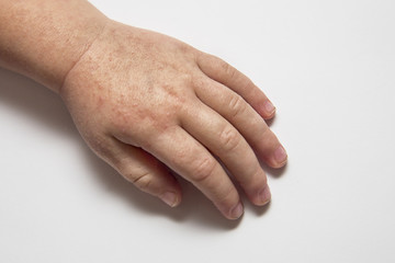 Fototapeta premium Scarlet fever. One children's hand with rash on white background.