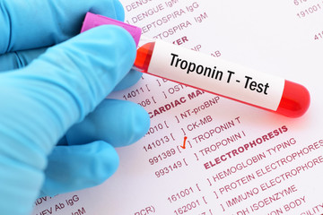 Blood sample for troponin-T test, heart disease diagnosis