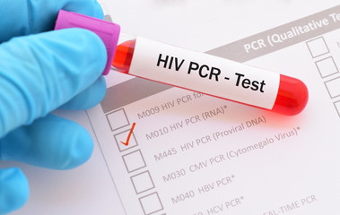 Blood sample for HIV PCR test