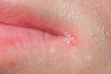 Wound on the lips, macro