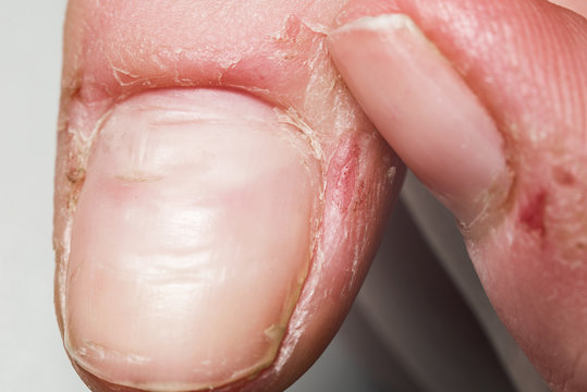 Damaged skin on the finger, burrs, macro