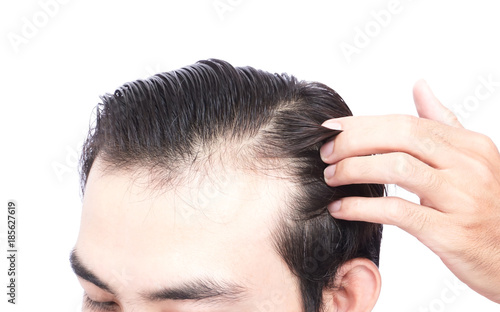 Young Man Serious Hair Loss Problem For Health Care Medical And