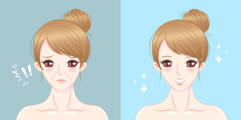 woman with nasolabial folds problem