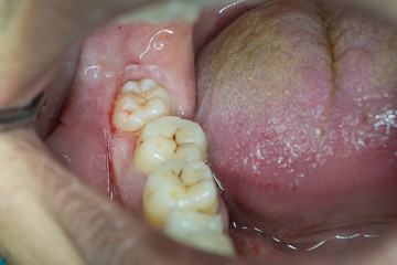 lower right wisdom tooth