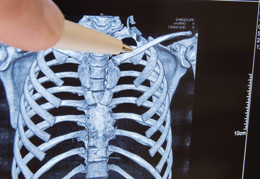 Doctor points out pen on clavicle in picture of 3D computer tomography. Anatomical location of collarbone and frequent destination of clavicle fracture with X-ray diagnostics in practice of trauma