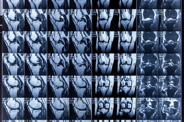 Magnetic resonance imaging (MRI) of human knee joint for medical diagnosis