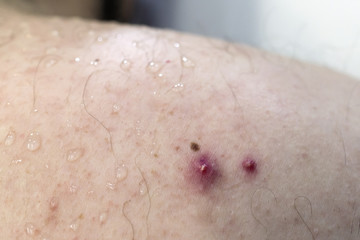 Two pimples with pus on the male back. Disease of the skin.