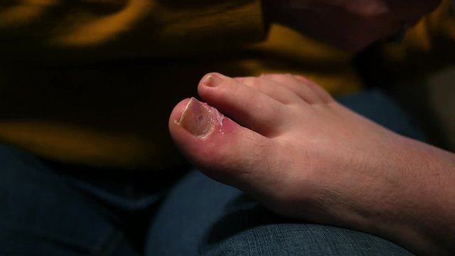 Close up of a red inflamed infected toe
