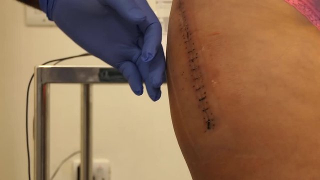 Close up of naked female hip after surgery.Male nurse wearing rubber gloves is removing metal clips or staples from healed wound using staple extractor or surgical removal tool