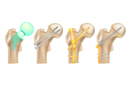 Hip fracture/ Illustration showing a variety of hip repair techniques