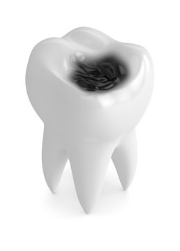 3d render of tooth with decay