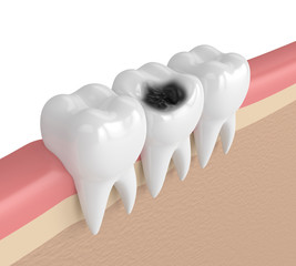 3d render of teeth  in gums with decay
