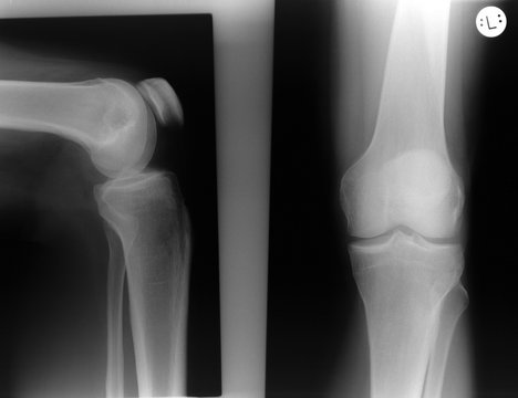 Röntgenbild eines Knies bei einem europäischen Mann.