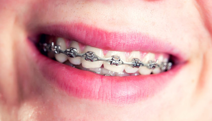smiling boy showing his fixed braces
