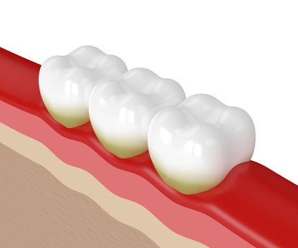 3d render of teeth with plaque and tartar