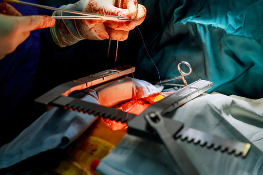 Invasive surgical approach with a small incision for heart valve surgery for removing expandable transcatheter aortic