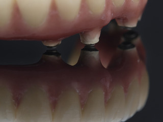 Mechanized connections. Complete lower prosthesis dental screwed