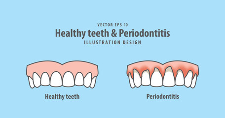 upper healthy teeth & Periodontitis illustration vector on blue background. Dental concept.