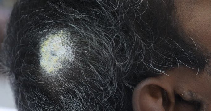 Male patient with Head wound