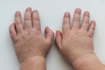 Scarlet fever. Two children's hands with rash on white background.