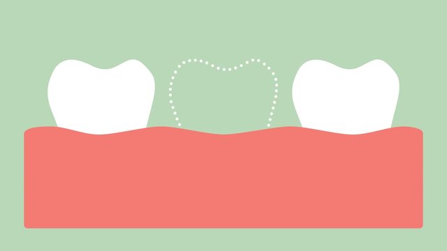 missing tooth, space in mouth - dental cartoon 2d animation in 4K