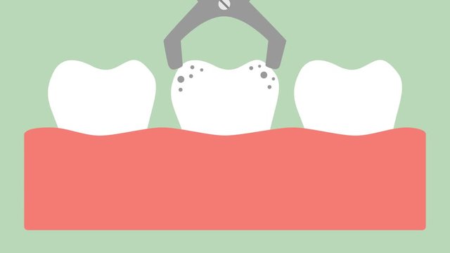 tooth extraction by dental tools, removal decay tooth - dental cartoon 2d animation in 4K