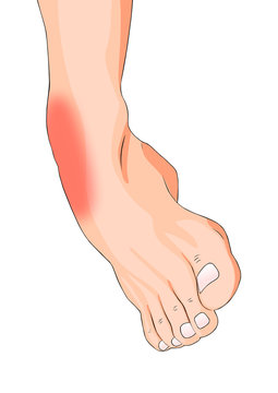 Ankle Sprain while Walking