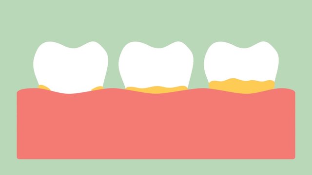 plaque on gum before gingivitis or gum disease - dental cartoon 2d animation in 4K