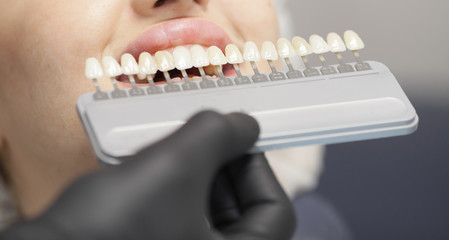 Beautiful european woman smile with healthy teeth whitening. Dental care concept. Set of implants...