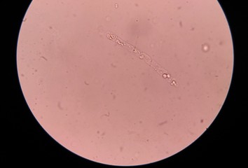 white blood cells cast in urine.