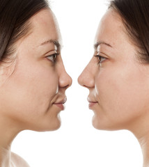 woman's profile, before and after nose surgery