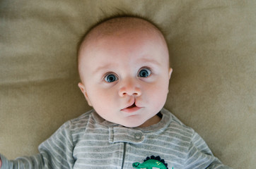 sweet infant with a cleft lip