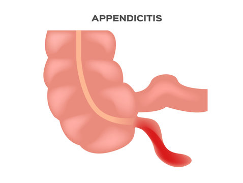 appendicitis vector in white background