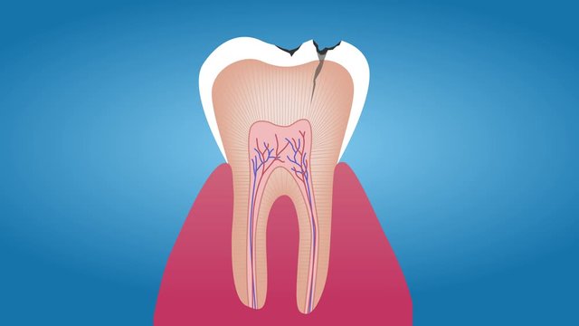tooth and gum anatomy and damage , graphic animation