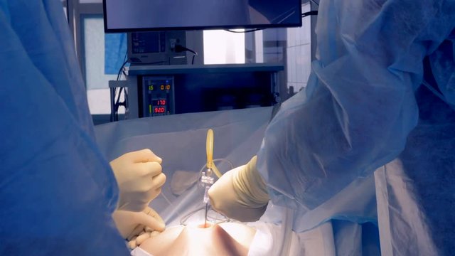 A patient undergoing a laparoscopic surgery. 