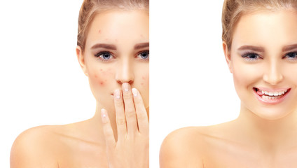 Post-Acne Marks /Treating Acne Scars