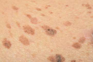 freckles on the skin
